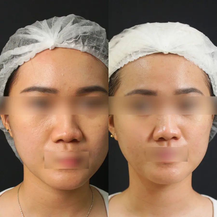 Before dan after treatment Acne Photofacial di Skinvest