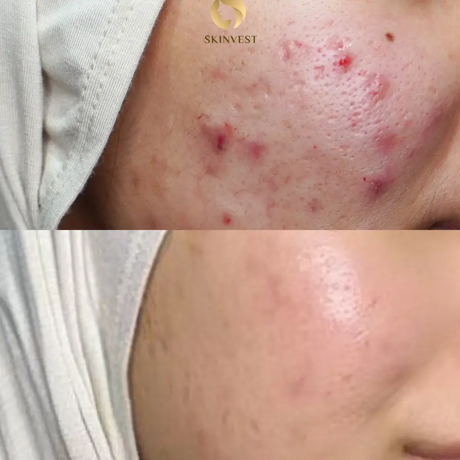 Before dan after treatment Acne Program di Skinvest