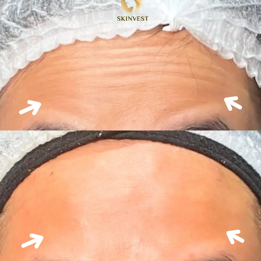 Before dan after treatment Botox di Skinvest
