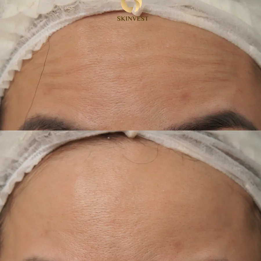 Before dan after treatment Density di Skinvest