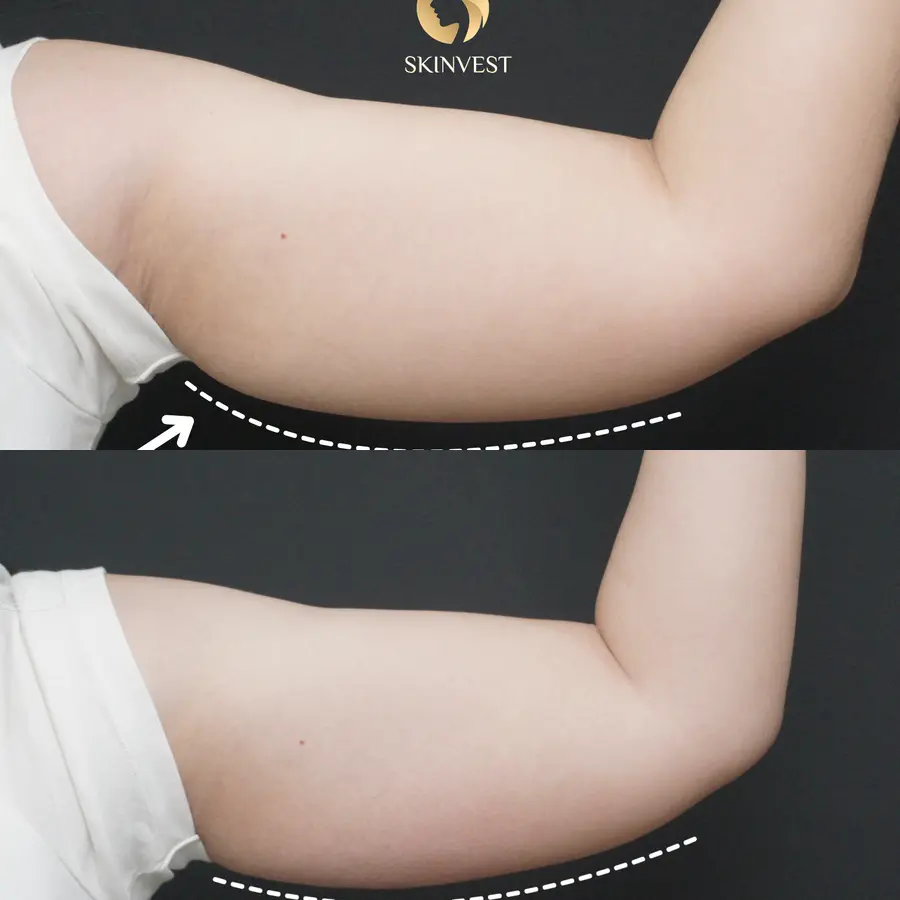 Treatment Fat Apoptosis Body