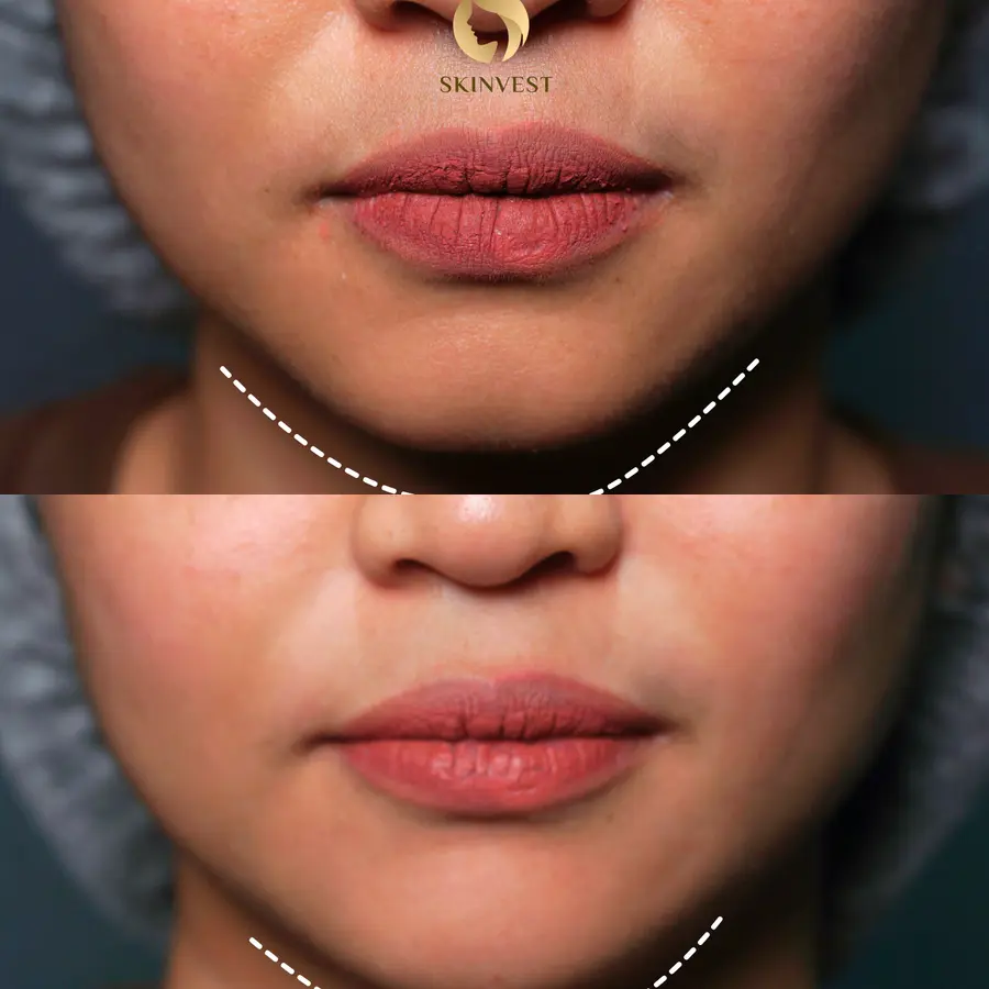 Before dan after treatment Filler Dagu di Skinvest