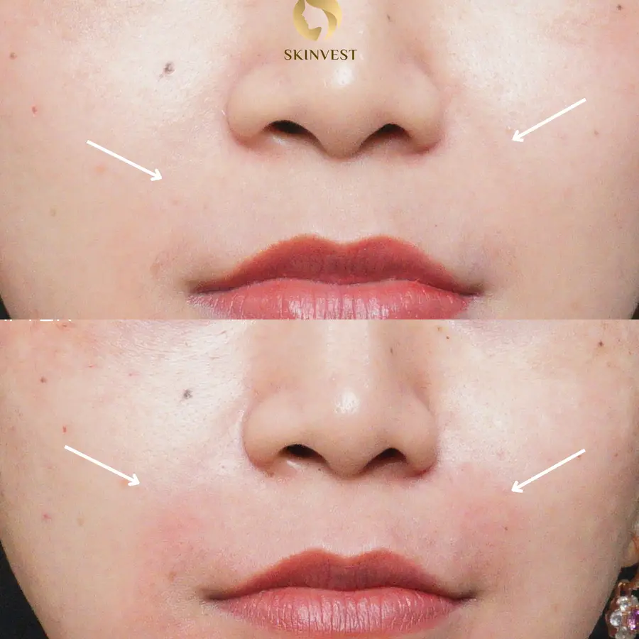 Before dan after treatment Filler Smile Line di Skinvest