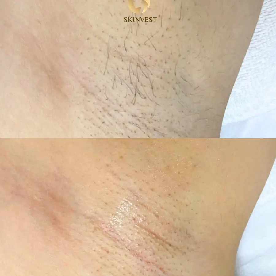 Before dan after treatment Hair Removal di Skinvest