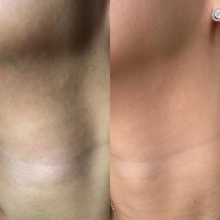 Before dan after treatment Juvelook di Skinvest