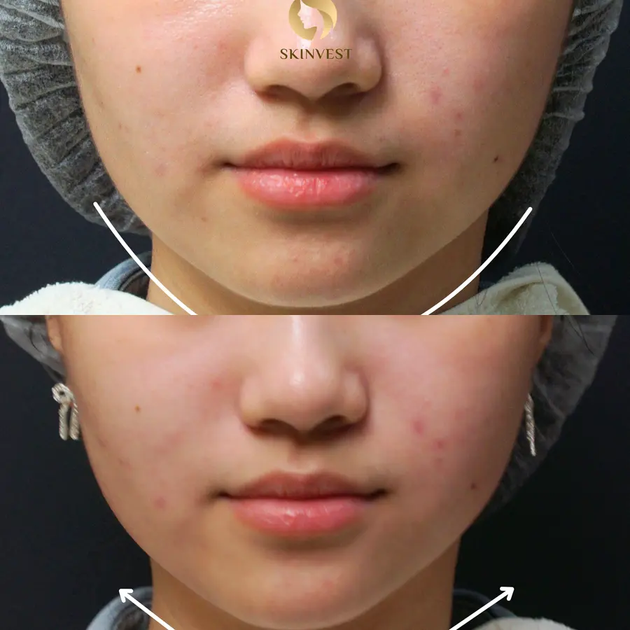 Before dan after treatment LIFU di Skinvest