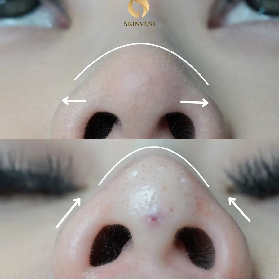 Before dan after treatment Nose Threadlift di Skinvest