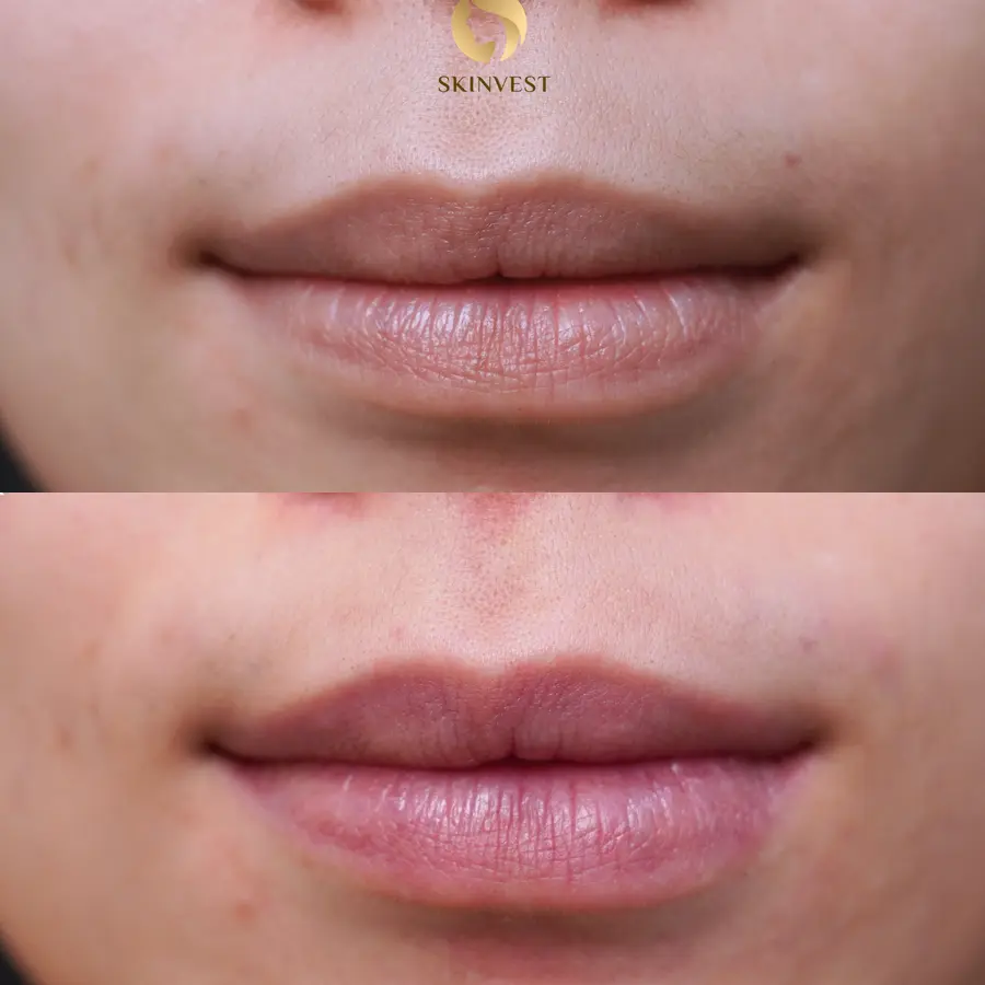 Before dan after treatment Pico Lips di Skinvest