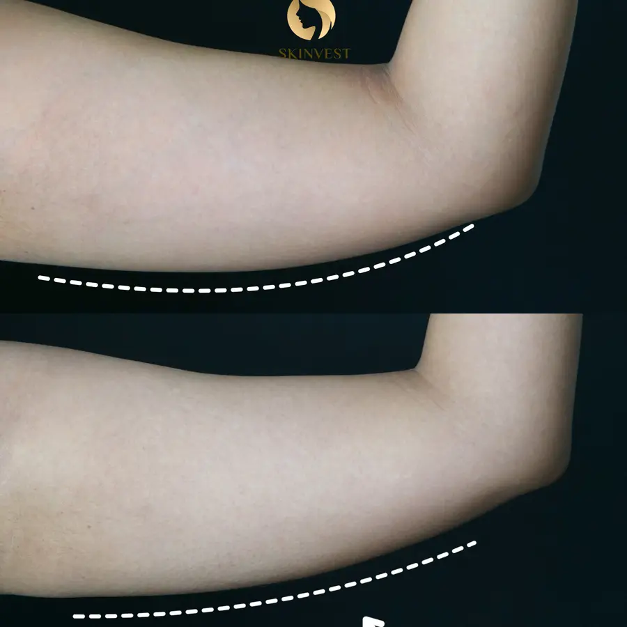 Before dan after treatment Treatment Slimming di Skinvest